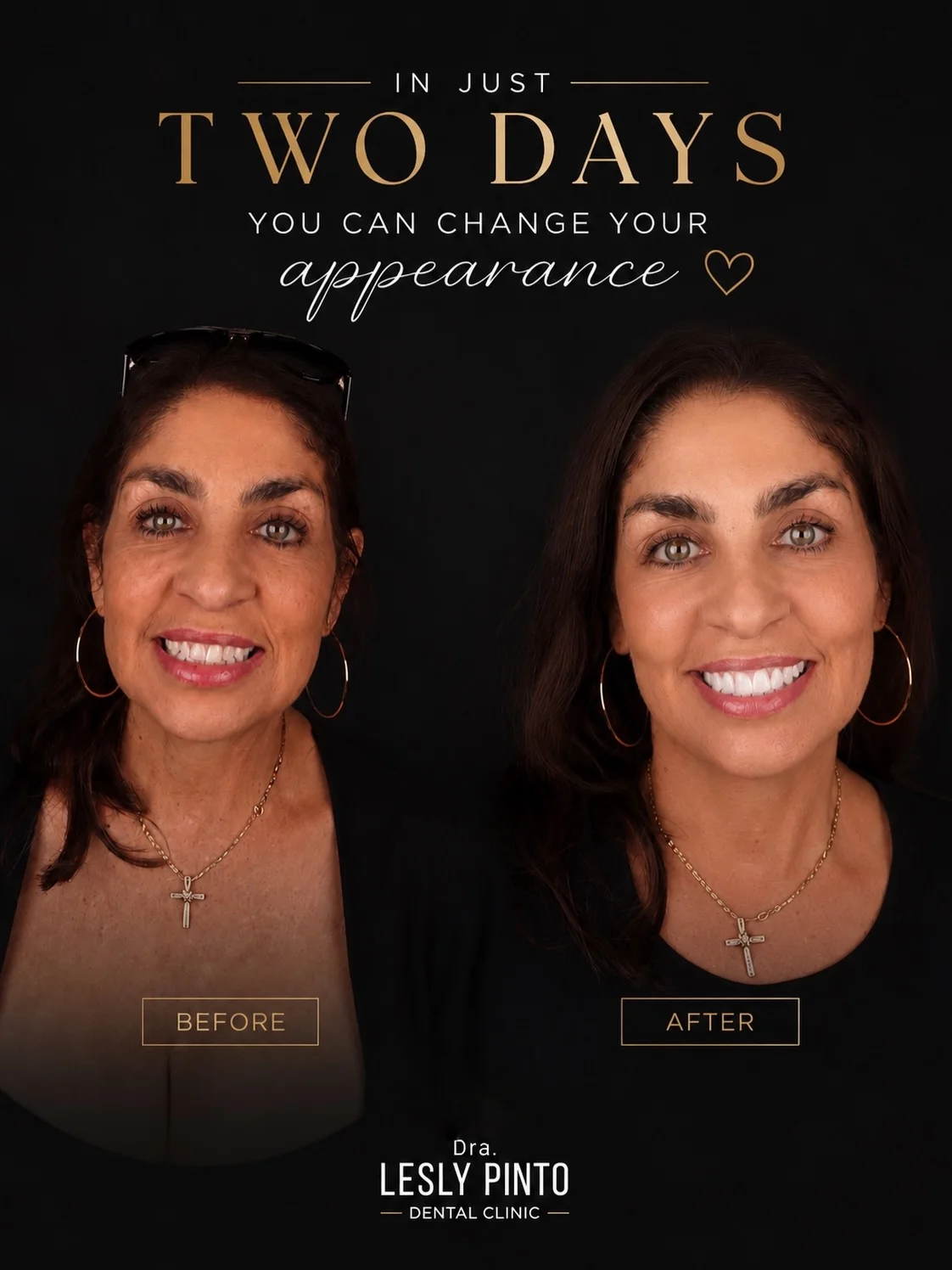 Female patient before/after porcelain veneers